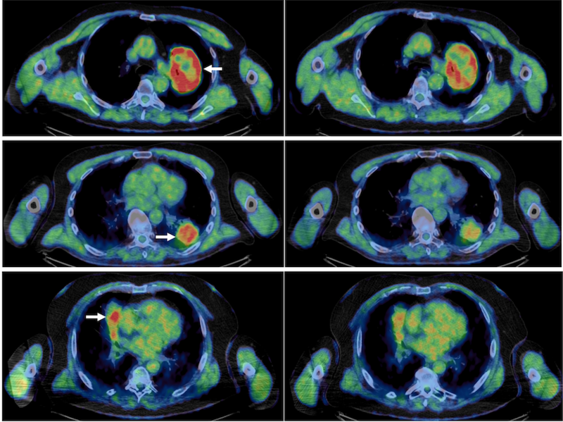 Pre and post atovoquone treatment lung scans in three patients, pre on the left, post on the right. The reduced amount of high intensity red references greater oxygen and thus a reduction in hypoxic environments. 